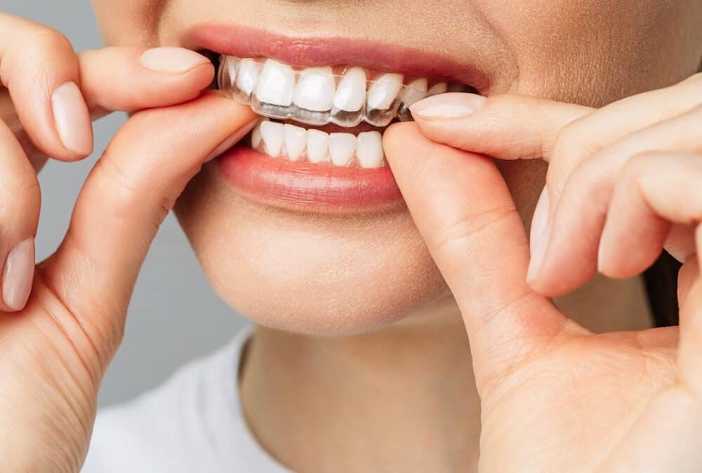 Invisalign