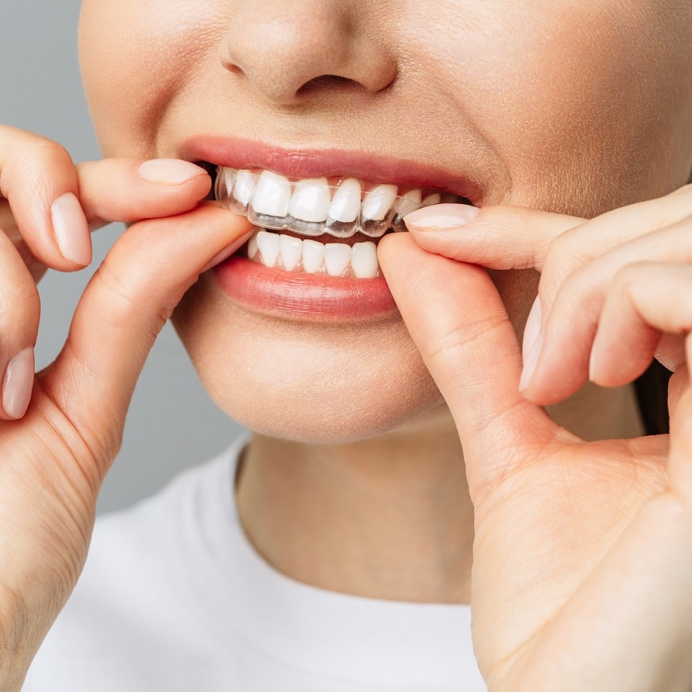 Signs Invisalign is Working in Marvin and Waxhaw NC