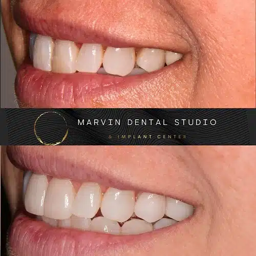 Professional Teeth Whitening